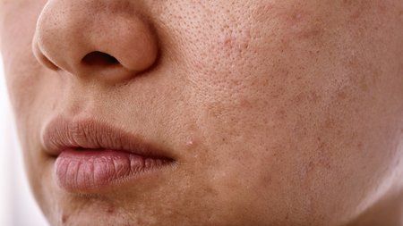What are Blackheads? Tips for Blackheads Garnier UK